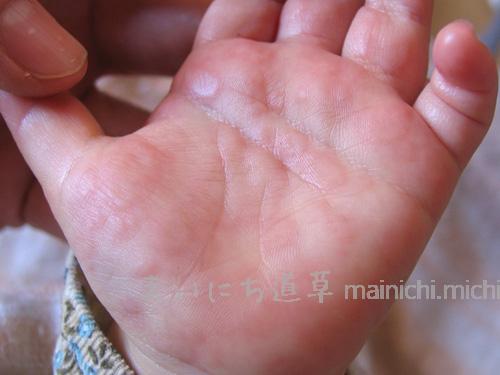 両手のひらに、赤い湿疹ができた 両手のひらに、赤い湿疹ができた