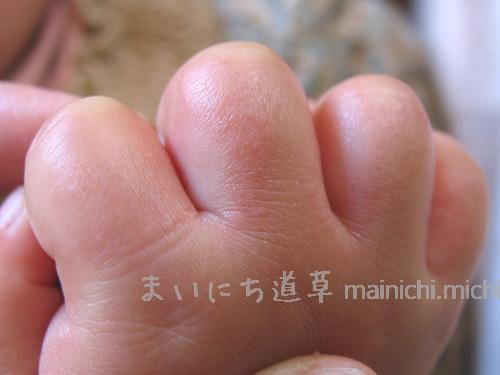 指の間も赤くなってる 指の間も赤くなってる