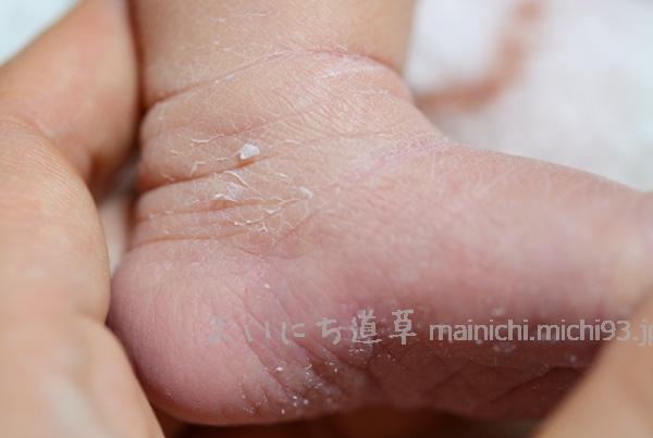 生後1週間、カサカサの皮膚がむけてきました 生後1週間、カサカサの皮膚がむけてきました